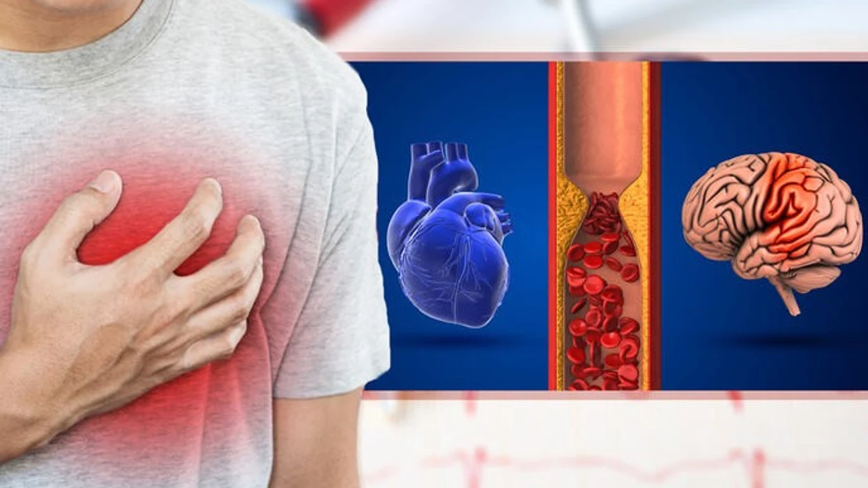 Fibrilacioni atrial dhe goditja në tru  Sa mund të ndihmojë aktiviteti fizik