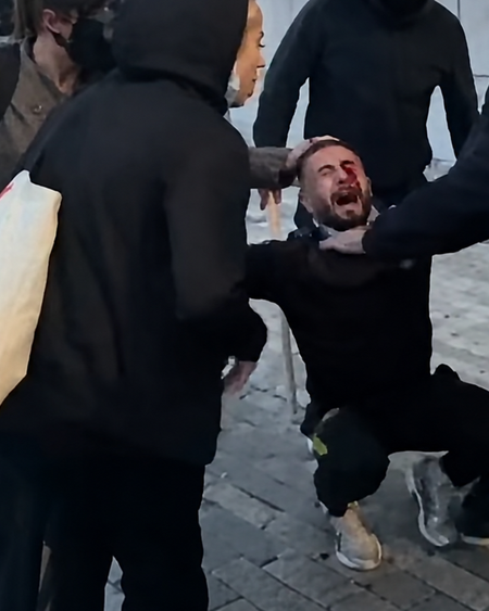PAMJET  Tjetër moment i rëndë nga protesta  i riu goditet në sy me plumb gome